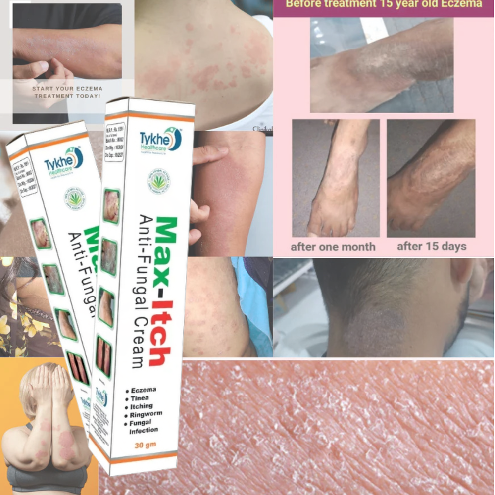 New Anti-Fungal UNANI Treatment Fast Relief Soothing Care Cream 30gm