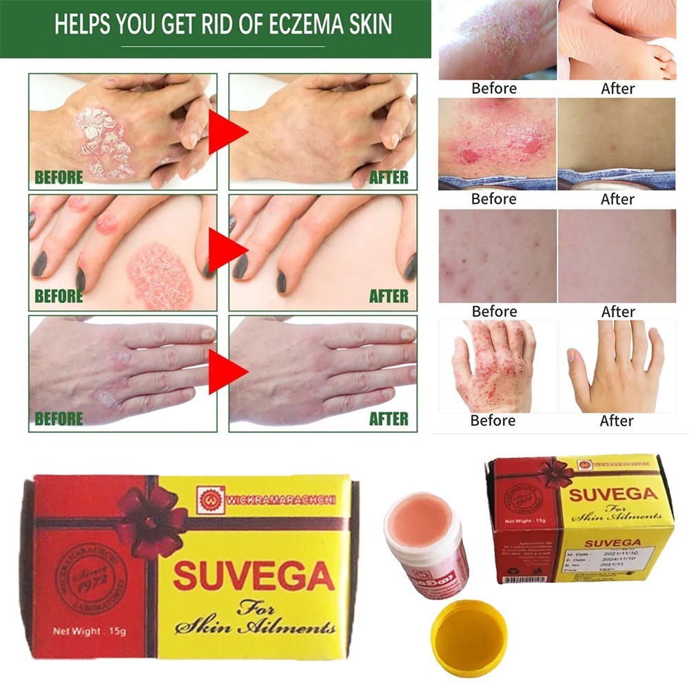 Antifungal Cream for Tinea Versicolor Eczema Heat Rash & Itchy Skin Relief  