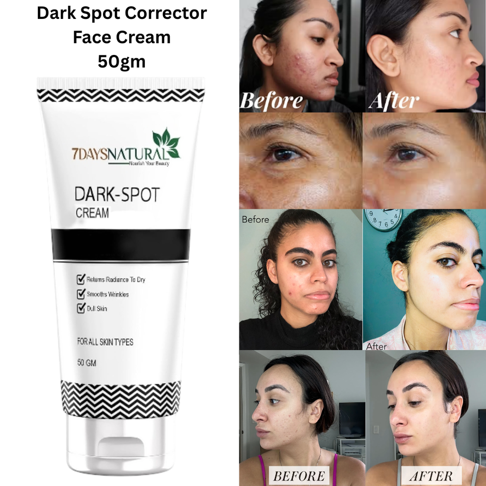 7 DAYS Natural Dark Spot Corrector Cream for Acne Marks & Hyperpigmentation 50g